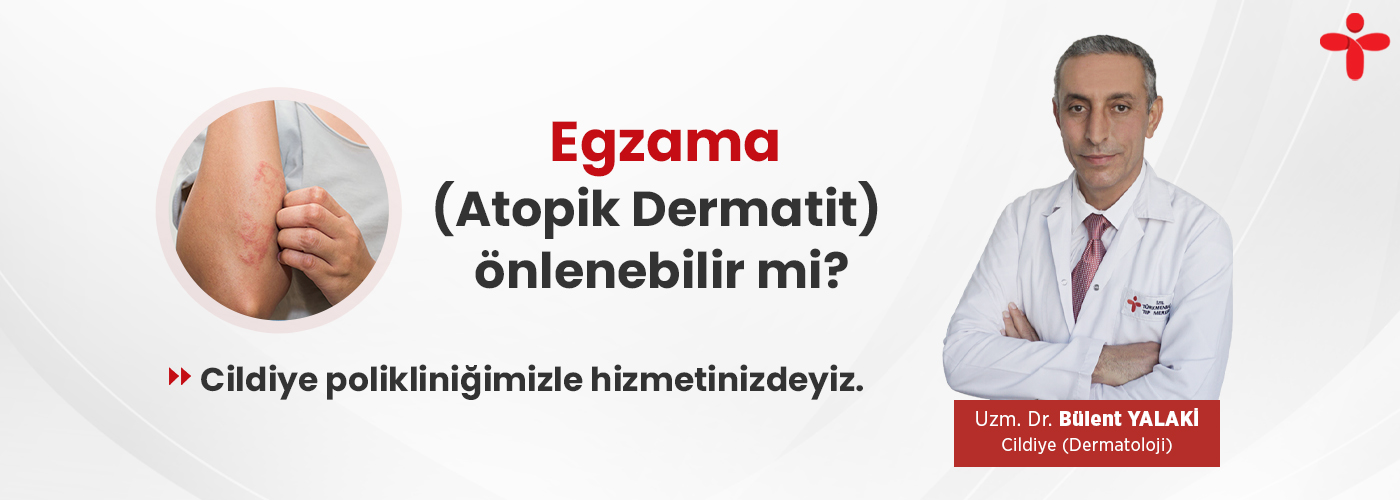 Egzama (Atopik Dermatit) önlenebilir mi?